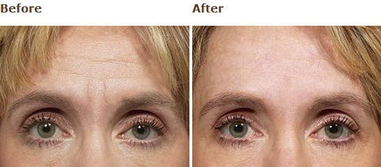 Frownies, the Natural Alternative to Botox