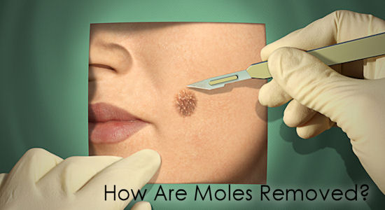 How are Moles Removed