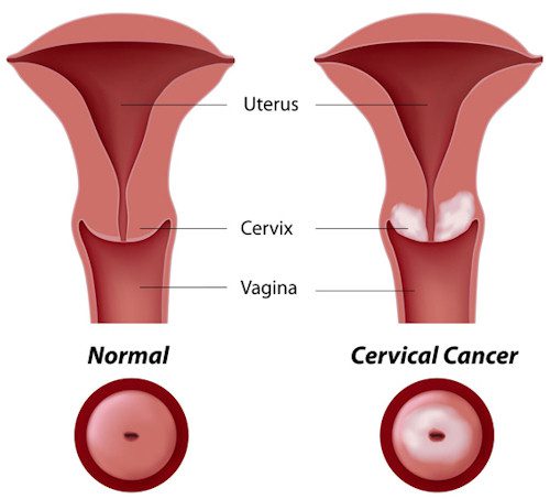 cervical cancer