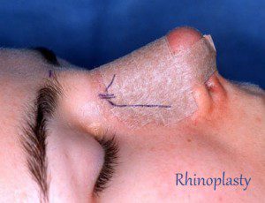 Rhinoplasty