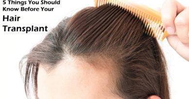 5 Things You Should Know Before Your Hair Transplant