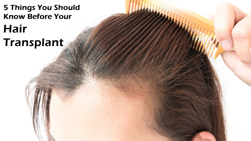 5 Things You Should Know Before Your Hair Transplant
