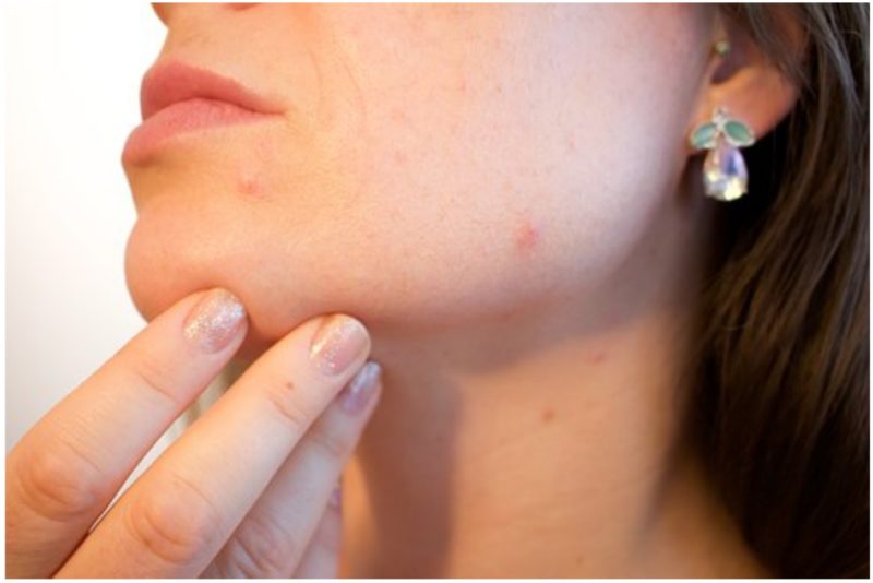 Skincare Tips For Acne-Prone Skin