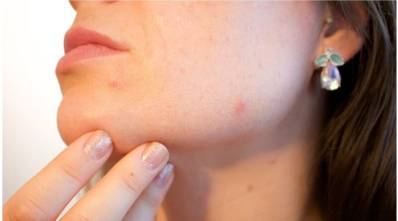 A Guide to Treating The Appearance of Acne Scars