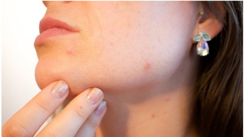 A Guide to Treating The Appearance of Acne Scars