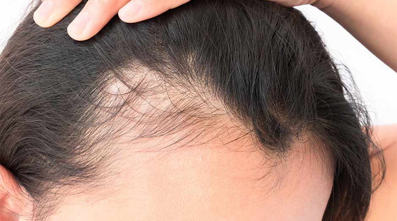 Treating Permanent and Temporary Traction Alopecia