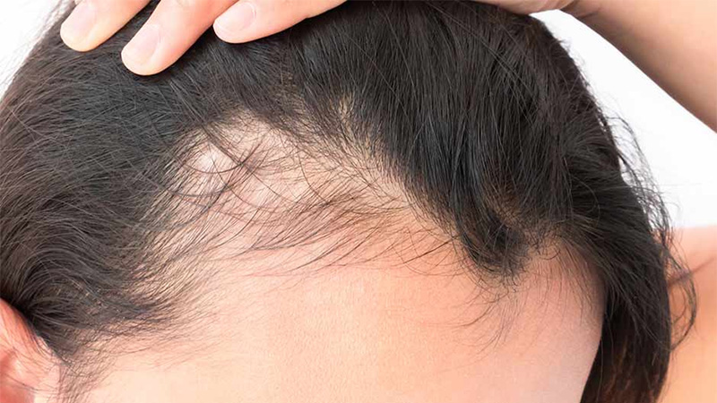 Treating Permanent and Temporary Traction Alopecia