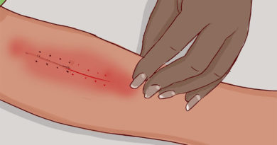 How to Deal With Surgical Stapler Scars