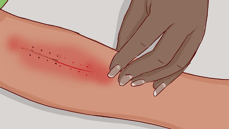 How to Deal With Surgical Stapler Scars
