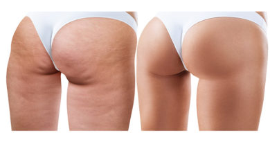 Here’s What You Need to Know About Cellulite & How to Handle It