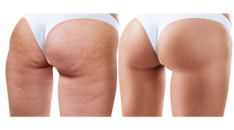 Here’s What You Need to Know About Cellulite & How to Handle It
