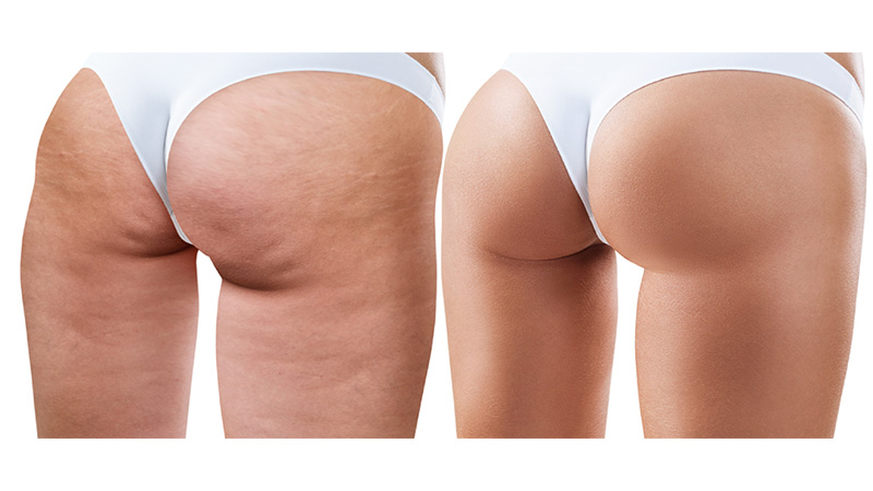 Here’s What You Need to Know About Cellulite & How to Handle It