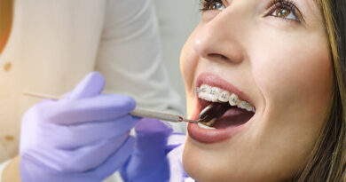 How to Choose the Right Type of Braces for You