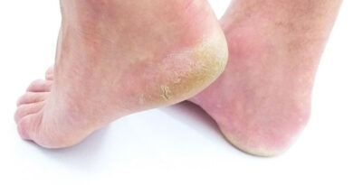 How to relieve foot problems