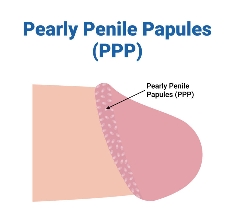 What Are Pearly Penile Papules (PPP)